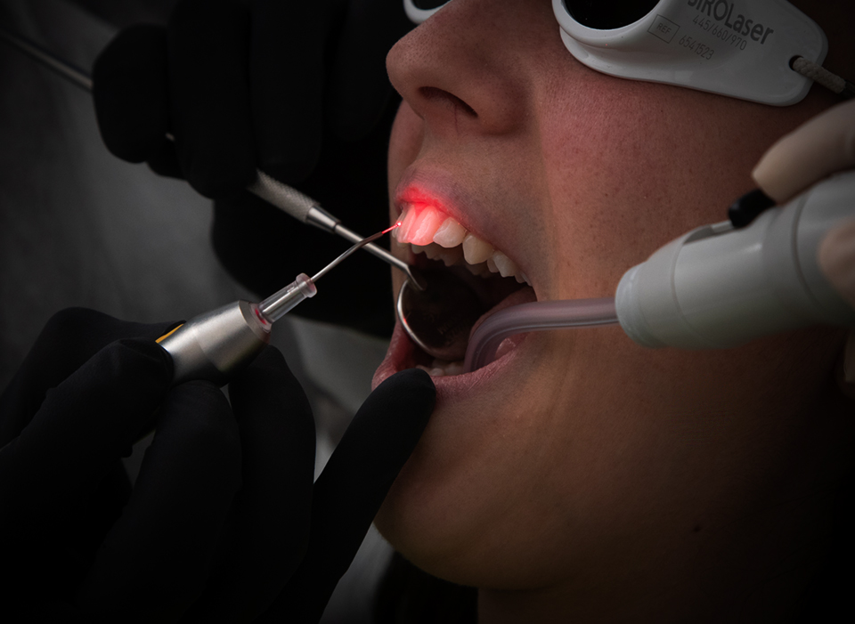 laser odontoiatrico